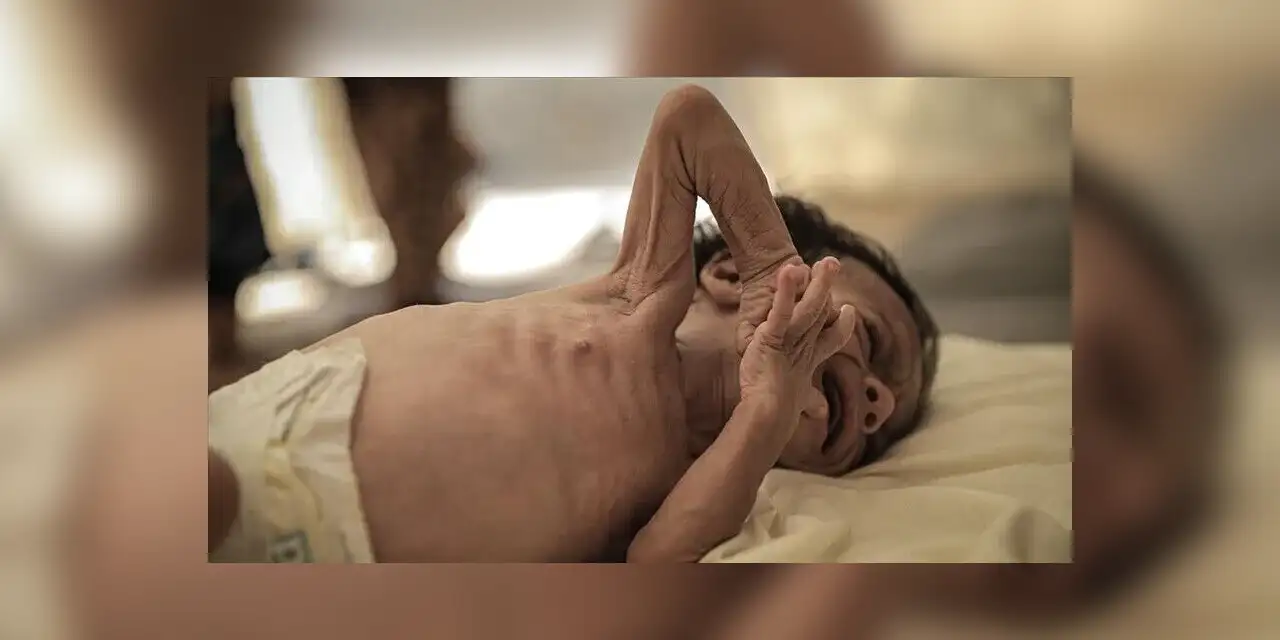 Bangladeş'teki kızamık salgınında hayatını kaybeden çocuk sayısı 779'a çıktı